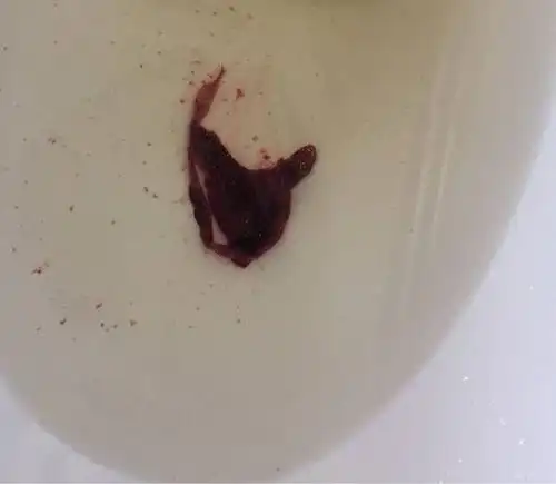 自然流产费用如何报销 自然流产生育保险报销