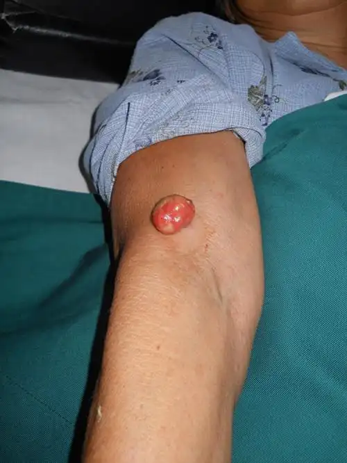 我院皮肤科报道国内罕见皮肤肿瘤病例