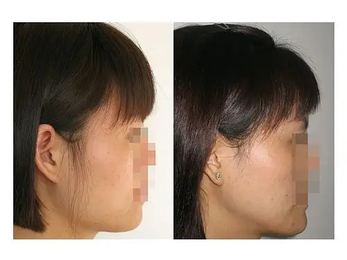 脸方打瘦脸针就能解决吗?不一定,要看你的脸方是什么原因造成的.