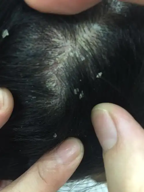 头皮上皮肤病跪求推荐医生,有的说是脂益性皮炎,有的说是癣,花了好