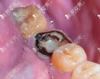 烂牙根终身不拔可以吗误信谣言拔掉牙根后悔不已