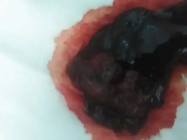 为什么怀孕40天会流黑色的血?是自动流产的现象吗?