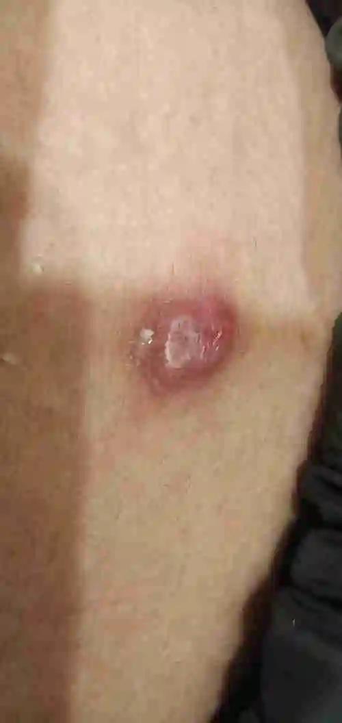 肚子眼下面有个包是怎么造成的 求解