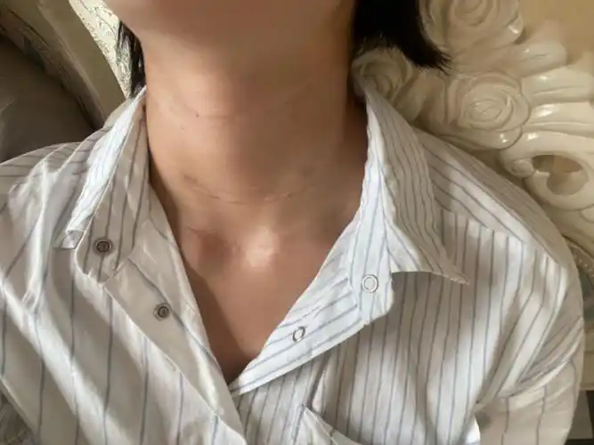一条颈纹老十岁 可我这天生的颈纹让我十分无奈