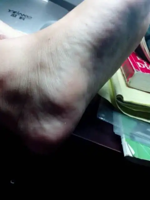 我今年16岁,女生脚的内侧有块硬的东