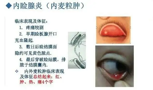 用针灸疗法一次治愈麦粒肿