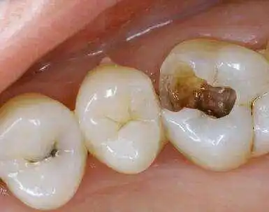 牙齿掉了一直不补会怎么样