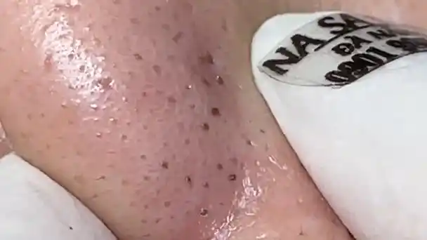 【挤黑头】全过程记录