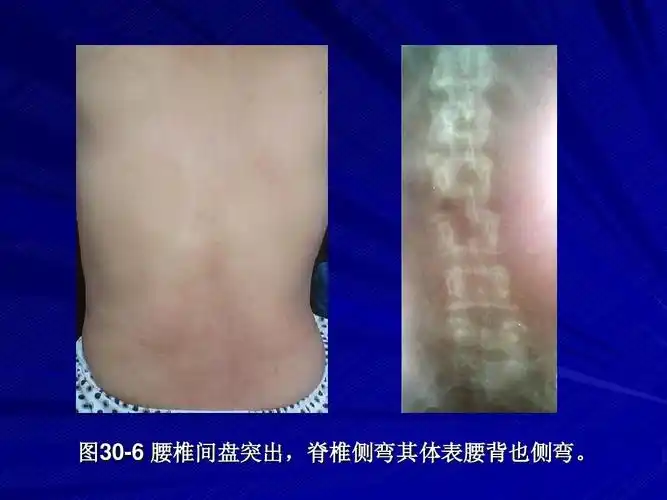 图30-6 腰椎间盘突出,脊椎侧弯其体表腰背也侧弯.