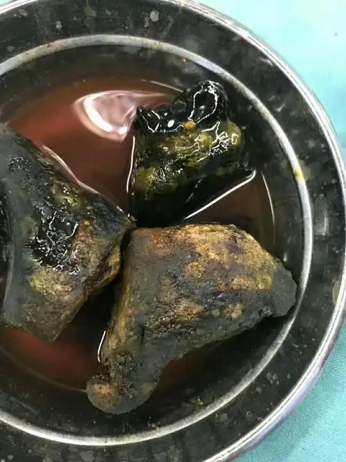 巨大胆管结石,长18cm,粗8cm,很罕见 - 好大夫在线