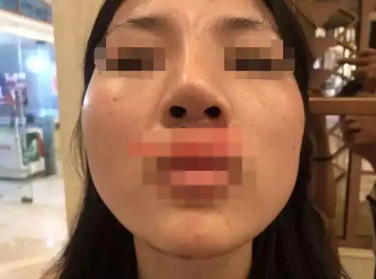 南昌某市民去整容医院做鼻子,消肿后发现鼻子歪了,医院却说.