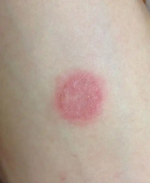 养猫之后身上起疹子该怎么办?