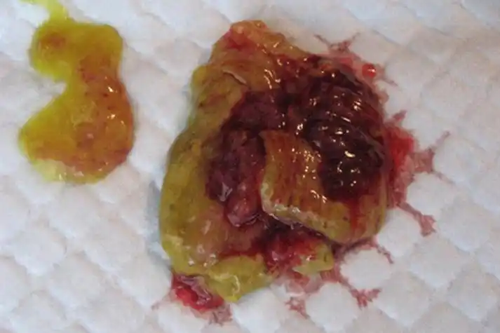 肠癌早期症状粪便图片_互联健康