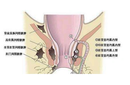 肛周脓肿的诱发原因