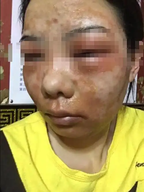 遭洗面奶毁容权健派老师24小时照顾她一个月