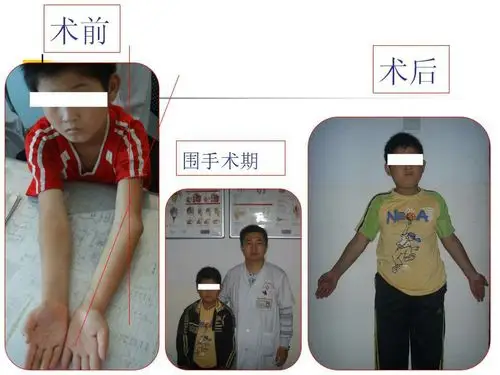 【创伤篇】 014 肱骨髁上骨折后继发肘内翻畸形的矫正治疗(病例展示)