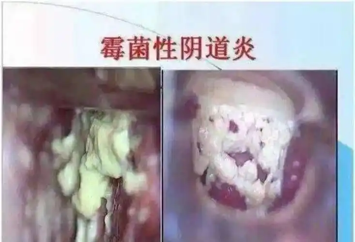 妇科疾病霉菌阴道炎图片_有来医生