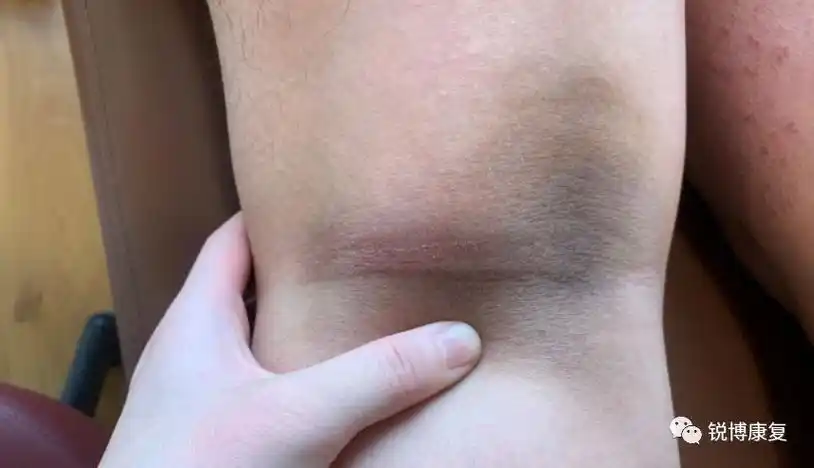 腘窝处淤青对于这种情况,如果不幸发生在了你身上,首先要做的就是停止