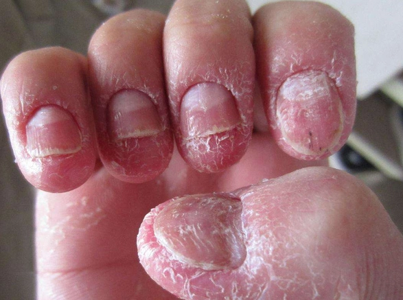 轻微灰指甲图片 (17)_有来医生