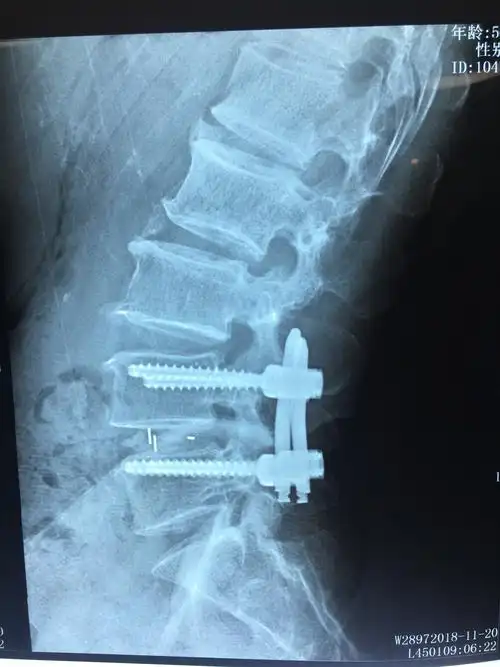 《经皮椎弓根钉通道扩张椎管减压椎间融合治疗腰椎管狭窄症》