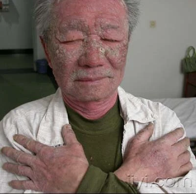 多形性日光疹的诊治