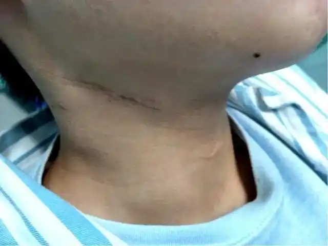 儿童甲状腺反复发炎,一定要警惕梨状窝瘘