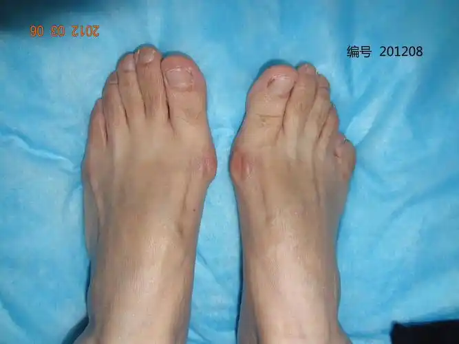 2012年3月拇外翻手术照片 - 好大夫在线