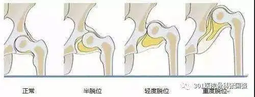 成人先天性髋关节脱位 怎么治?