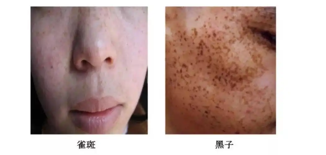 雀斑的诊断流程和治疗方法【许昌市人民医院整形美容外科】