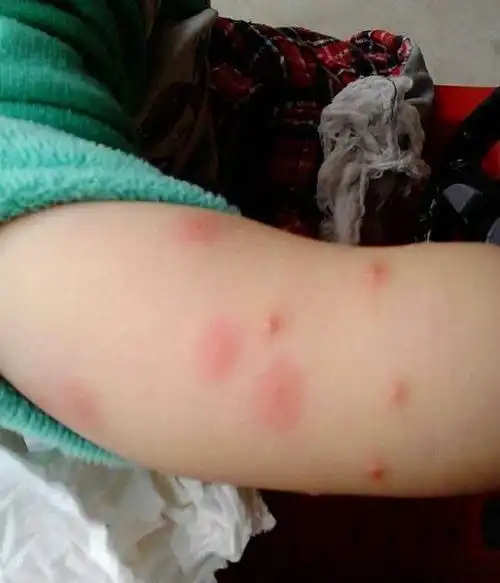 1岁宝宝胳膊上起了红点医生检查后真相妈妈不愿意相信