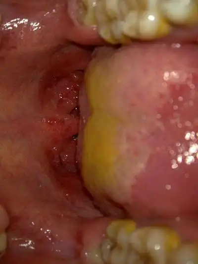 扁桃体肿大图片50