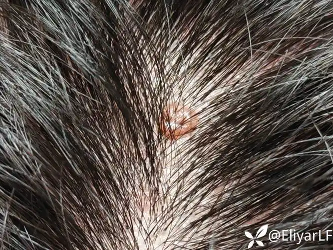 求助头皮疣状物物