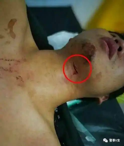 江西一民警处警险遭割喉:行凶者行政拘留10日