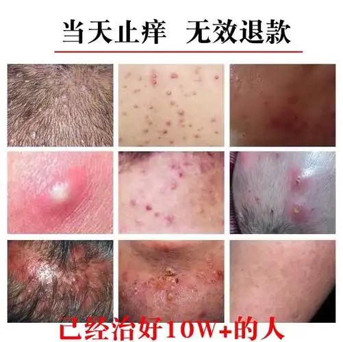 治疗头皮毛囊炎堵塞神器去鸡皮肤疙瘩脓包疥疮角质全身背腿部药膏