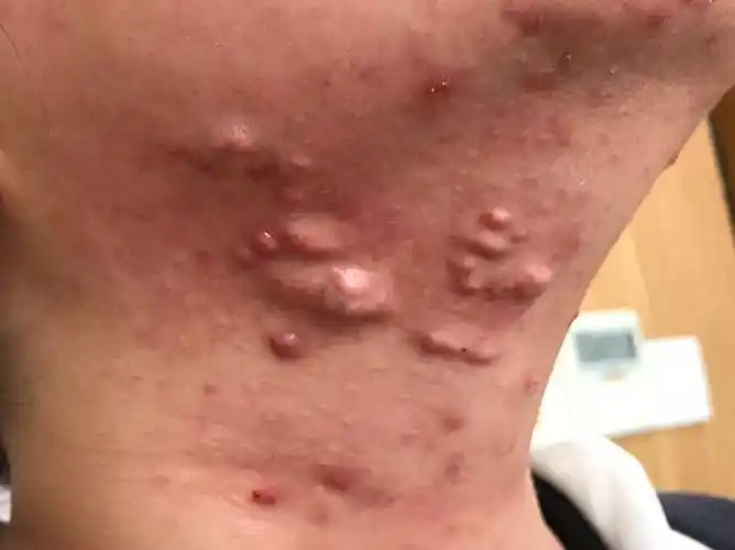 例二,男士,   岁,痤疮  年,反复发作,呈结节和脓包型,迁延不愈.