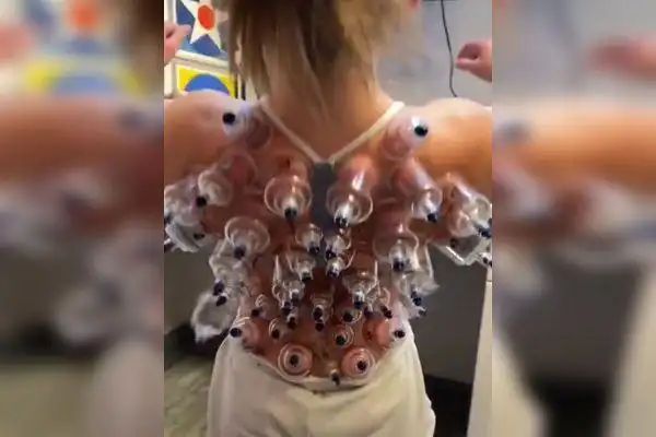 美女后背拔罐这也是太奇葩啦,满后背的罐子像眼睛一样扣在背上