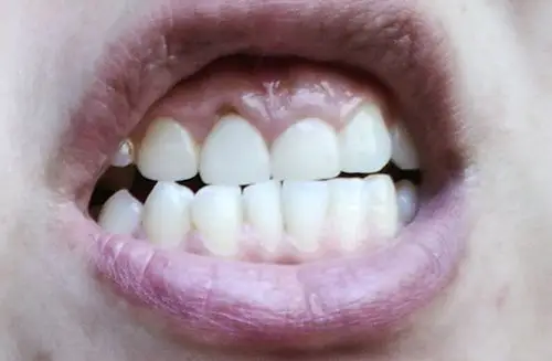 这属于牙龈萎缩么