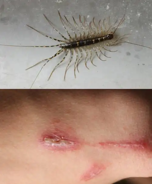 胳膊上貌似是被虫子爬过的痕迹,有5公分细长条状红肿,一端起了好多