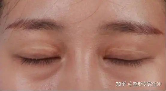 割双眼皮是微整小手术这9大双眼皮失败表现你有必要知道