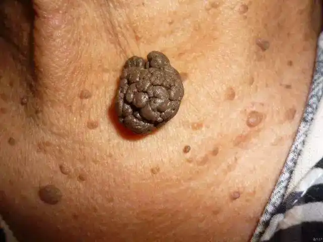 皮肤赘生物扁平疣汗管瘤粟丘疹刺瘊的专业知识