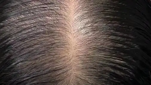 女士脱发发量稀疏发缝宽大,加密后效果很不错 #增加发量 #脱发 #纹发