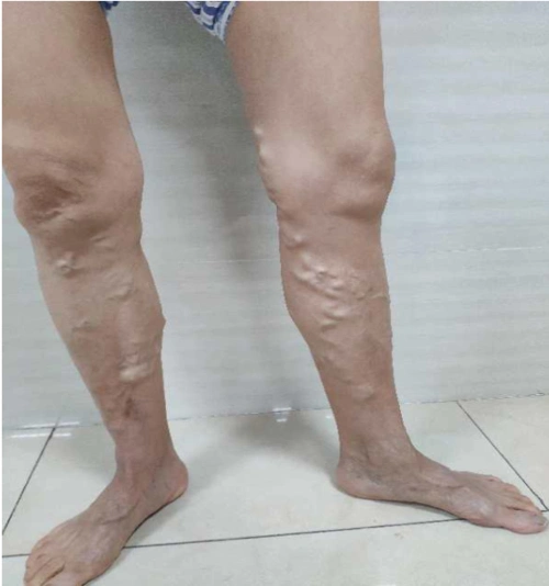 春山如笑!小腿静脉曲张怎么治疗?"勇往直前"-第1张图片-天成博客