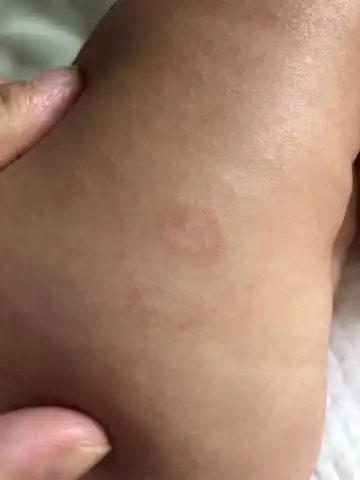 宝宝大腿内侧外侧有这种圆形的皮疹,不知道是什么～这个位置是纸尿裤