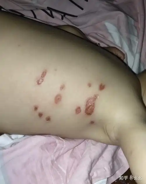 记录一岁宝宝病毒性疱疹的护理