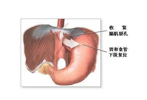 食管裂孔疝修复-手术图解,_医学图库