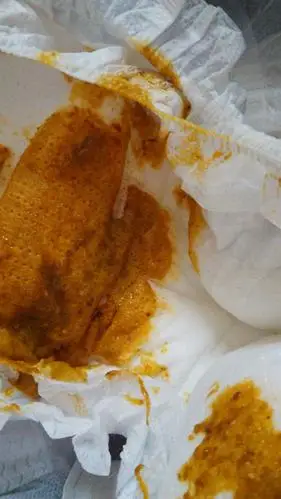 57天的宝宝这两天有点鼻塞着凉～大便次数增多,今天拉的粑粑有泡沫