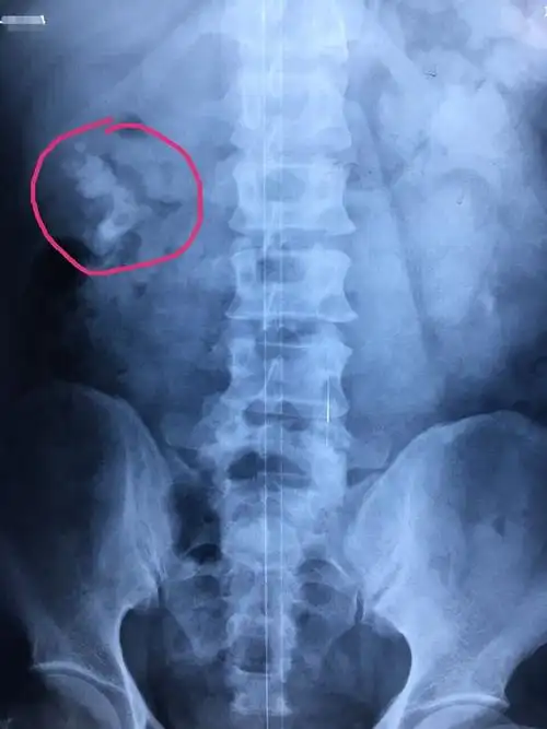 复杂性肾结石手术展示