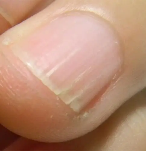 手指甲开裂,出现条纹