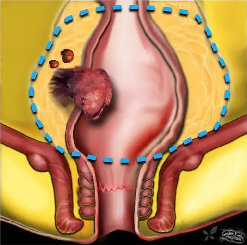 果断收藏:直肠癌诊断分期图谱