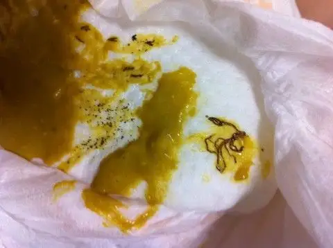 里面有这些东西,不知道是什么,用棉棒弄一下就变成小点点,像虫卵一样